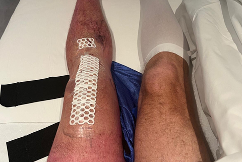 What Is a Total Knee Replacement?